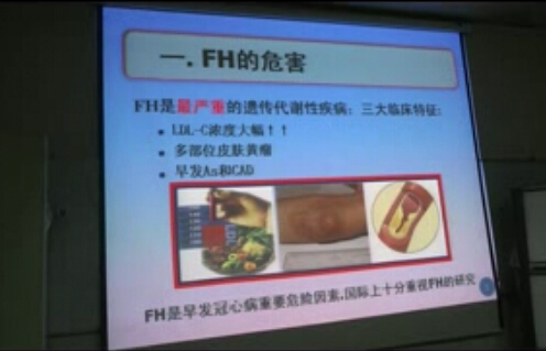 家族性高胆固醇血症临床研究进展速递——王绿娅精彩演讲